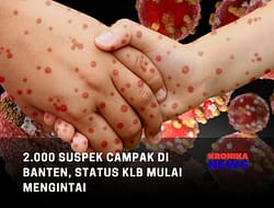 2.000 SUSPEK CAMPAK DI BANTEN, STATUS KLB MULAI MENGINTAI
